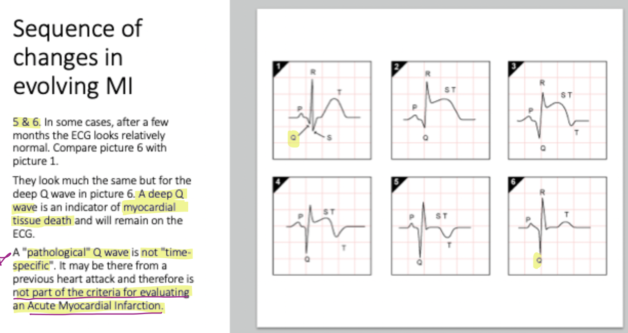 <p>A <strong>pathological Q wave is not 'time-specific' </strong>and serves as a <em>permanent record of a previous heart attack</em></p>
