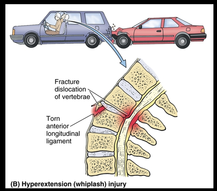 <p><span>-Results from severe hyperextension of the neck, as occurs in during rear-end motor vehicle collisions, especially when the head restraint is too low</span></p><p><span>-Anterior longitudinal ligament is severely stretched and may be torn</span></p><p><span>-May injure posterior parts of the vertebral arches and their processes</span></p>