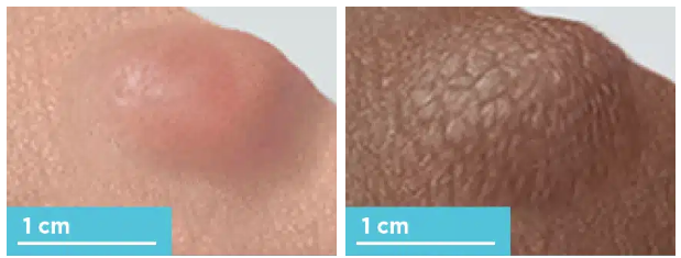 <p>What kind of lesion is this?</p>