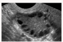 <p>The “string of pearls sign”: a rounded ovary with multiple small immature follicles on the periphery is what condition?</p>