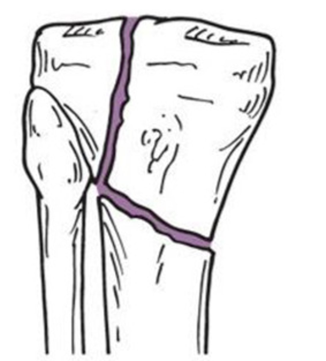 <p>What type of fracture does this show?</p>