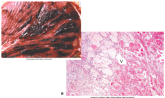 <p>What is the etiology of clostridial myositis?</p>