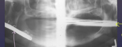 <p>the following patient has a surgical plate. What type of image is the purple arrow pointing to?</p>