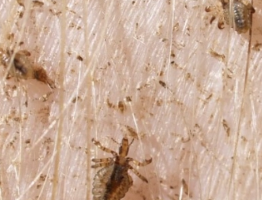 <p><u>Species:</u> <em>Haematopinus suis</em> = Sucking louse</p><ul><li><p>Largest domestic louse species</p></li><li><p>Pig hairs are coarse and far apart</p></li></ul><p><u>Effects:</u> Irritation and anaemia proportional to numbers present</p><ul><li><p>Symptom of poor husbandry in backyard piggeries and lifestyle blocks</p></li></ul><p><u>Treatment:</u> Repeat treatment q10 - 14d (very hard to get drug to persist on sparsely haired pig skin)</p>