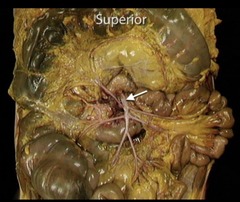 <p>In this anterior view of the contents of the abdomen, the greater omentum and transverse colon have been reflected superiorly. Identify the vessel indicated by the arrow.</p><p>Inferior mesenteric artery</p><p>Intestinal artery</p><p>Portal vein</p><p>Superior mesenteric artery</p>