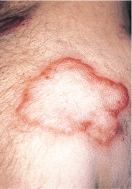 <p><span>Having a wavy margin; used to describe skin lesions, ulcers or GI lesions</span></p>