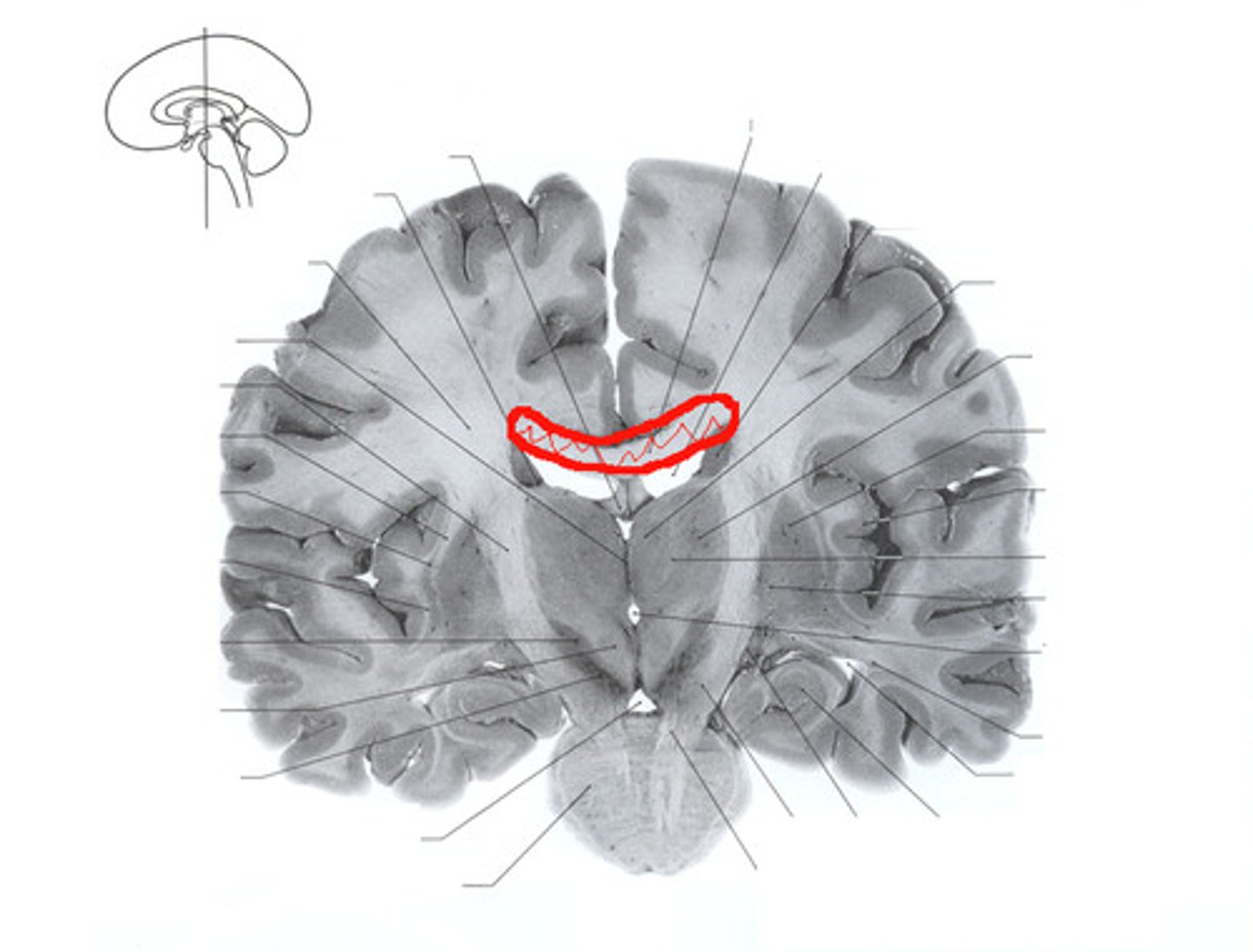 <p>A prominent commissural fiber tract that is readily observable in midsagittal sections of the brain, connects the two cerebral hemispheres.</p>
