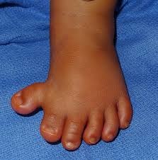 <p>Polydactyly is an abnormality characterized by extra fingers or toes, it can be syndromic or non-syndromic. When it occurs by itself with no other abnormalities it is inherited in an autosomal dominant pattern. There are many different genes associated with nonsyndromic polydactyly including HOX genes, hedgehog pathways, FGFs, and more.</p>