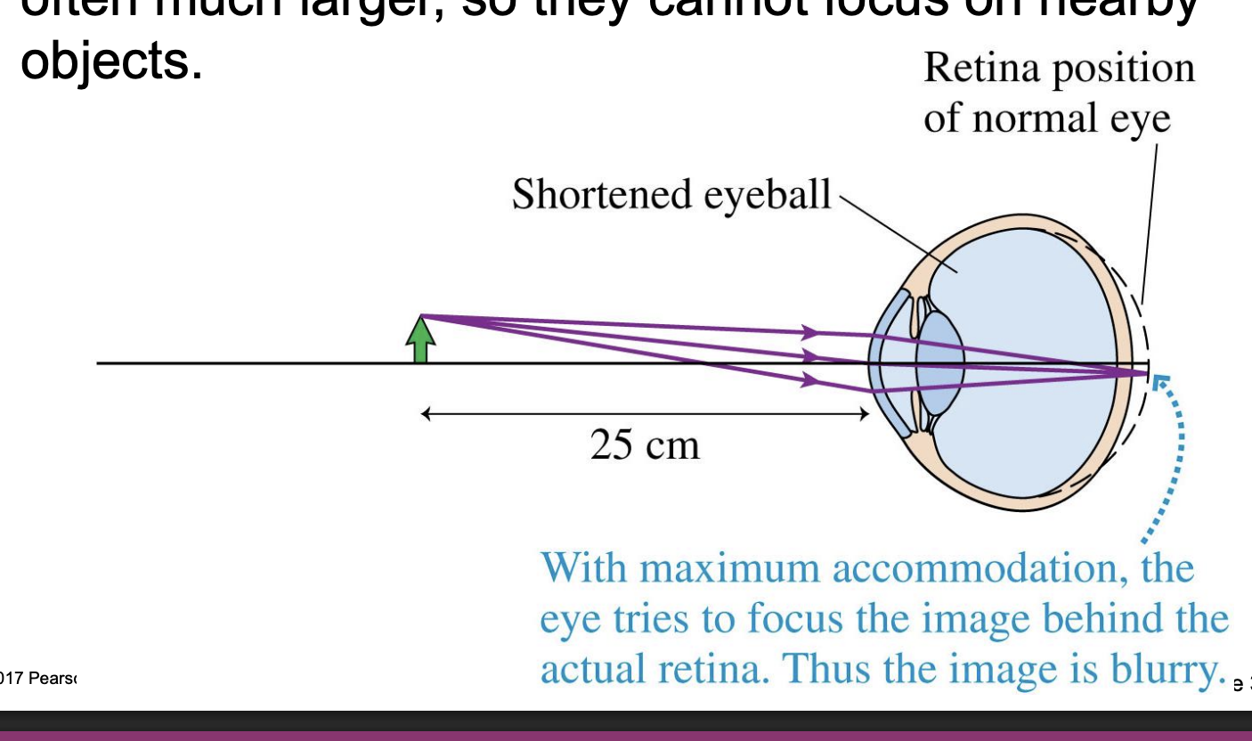 <p>-A person who is <strong>farsighted </strong>can see faraway objects clearly, but their near point is larger than 25 cm, often much larger, so they cannot focus on nearby objects.</p><p>*eye stretched long way so light not focused on retina</p>