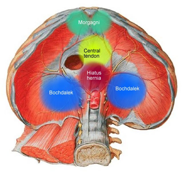 <p><br><span>a birth defect in the diaphragm allowing abdominal contents to move into the thoracic cavity, potentially causing respiratory distress and other complications in the newborn.</span></p>