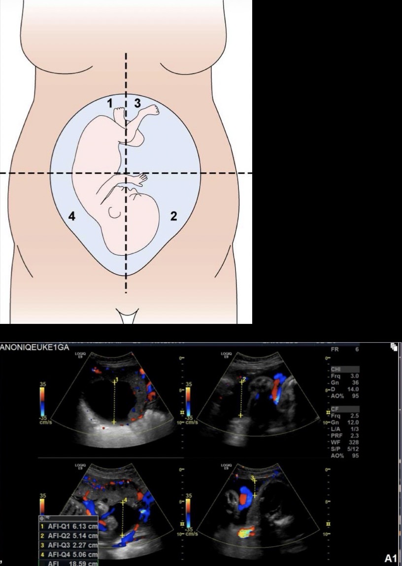<p>Gravid uterus is divided into 4 equal quadrants; AP diameter of deepest amniotic fluid pocket free of cord and extremities is measured in each quadrant; these 4 measurements are added together to determine the AFI (sum of 8-25cm is considered normal)</p>