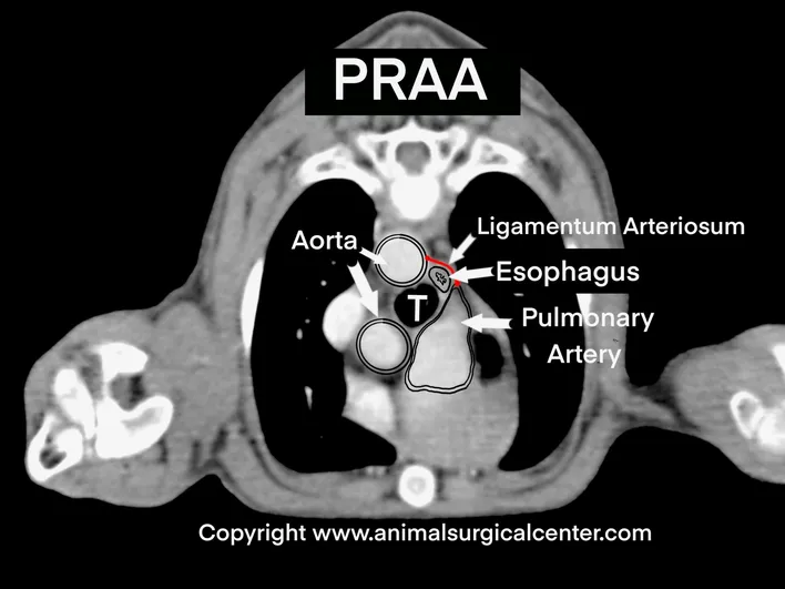 <p>A process where the left $$4\text{th}$$ arch develops into the adult aortic arch and the ductus arteriosus originates from the left side of the main pulmonary artery (MPA) trunk.</p>