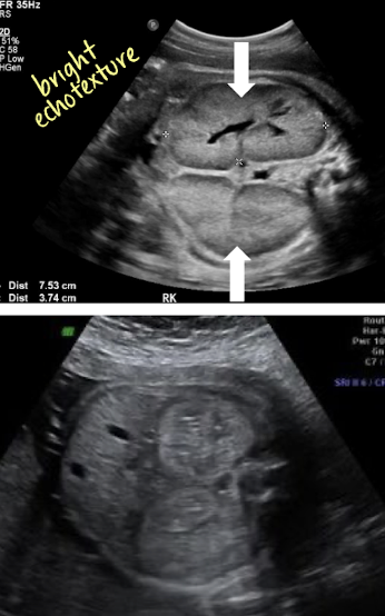 <ul><li><p>bilateral, enlarged, echogenic kidneys</p><ul><li><p>individual cysts not identified</p></li></ul></li><li><p>kidneys are symmetrically enlarged</p><ul><li><p>3-10x normal renal size for GA</p></li></ul></li><li><p>AC will be large</p></li><li><p>bladder may be present or small</p></li><li><p><span style="color: red;">oligohydramnios</span></p></li></ul><p></p>