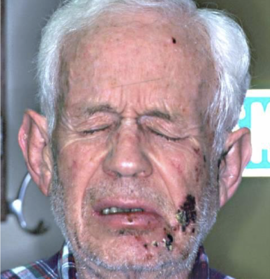 <p>what is this lesion associated with and why is it black</p>
