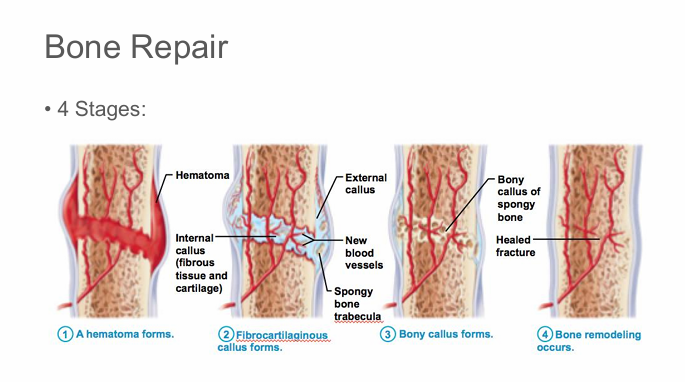 <ol><li><p>Hematoma formation</p><ul><li><p>Clotted blood from torn blood vessels</p></li></ul></li><li><p>Soft callus formation</p><ul><li><p>Macrophages clear cellular debris</p></li><li><p>Collagen fibers connect broken ends to allow catilage to be laid down</p></li></ul></li><li><p>Hard callus formation</p><ul><li><p>Trabeculae are formed from cartilage, and lay down spongy bone</p></li></ul></li><li><p>Bone remodeling</p><ul><li><p>Spongy bone remodelled into compact bone and excess bony material is removed</p></li></ul></li></ol><p></p>