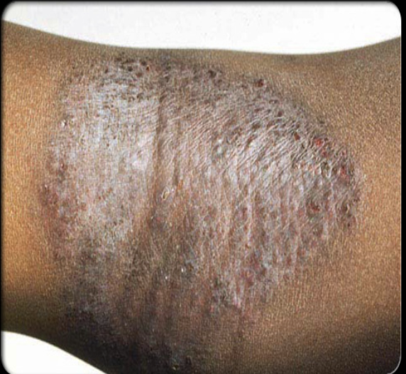 <p>The most common inflammatory skin disorder; includes irritant, allergic, and atopic dermatitis.</p>