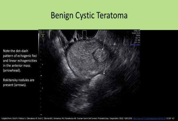 <p>A. a teratoma</p><p>The dot-dash pattern refers to the sonographic appearance of the dermoid mesh . Short and long echogenic lines caused by hair in the mass can be identified in an ovarian teratoma.</p>