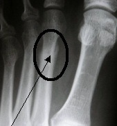 <p>Repetitive loading → microfracture</p><p>Localized point tenderness, worsens with activity; focal bony tenderness, possible swelling</p>
