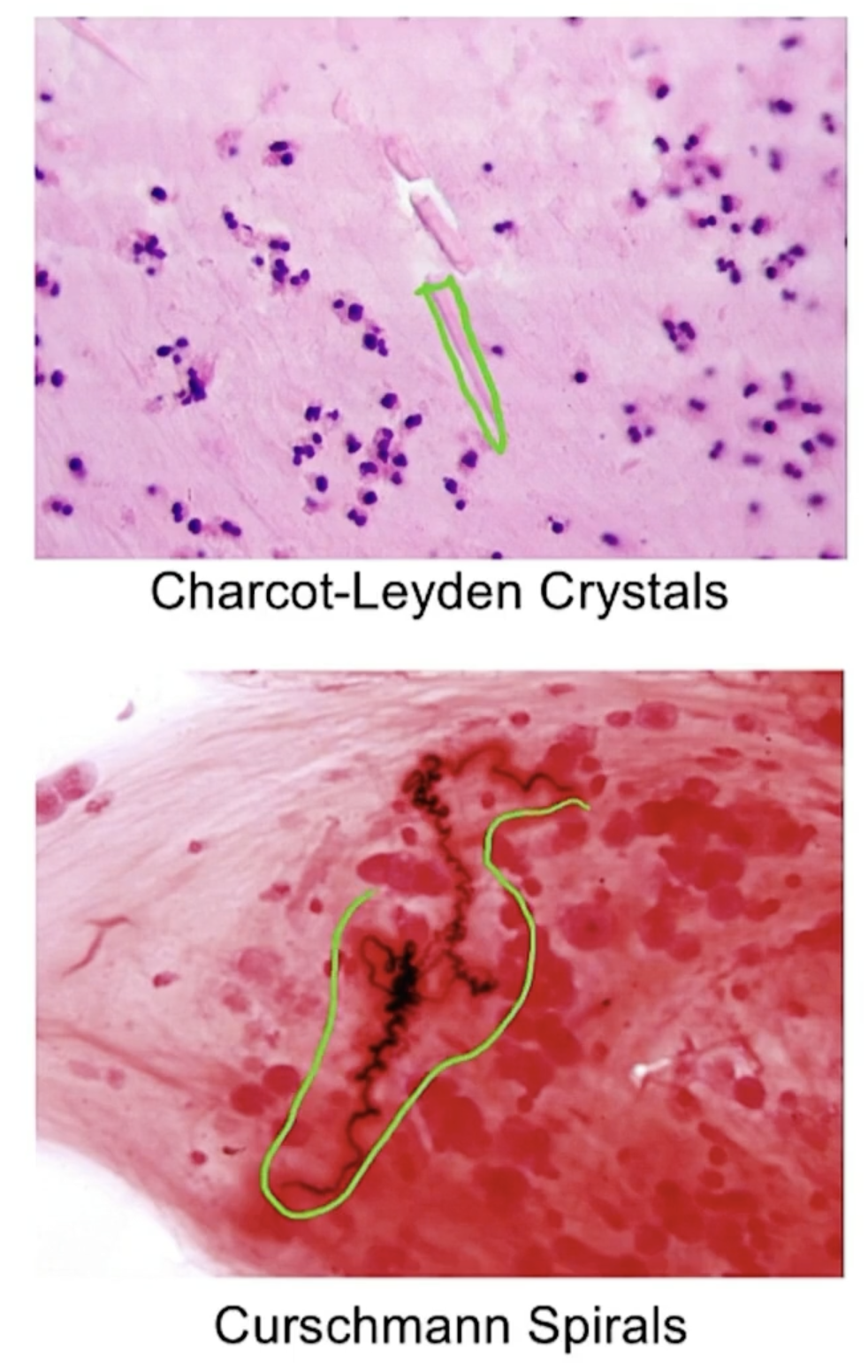 <p><strong><u>Definition</u></strong>: Episodic & reversible bronchoconstriction </p><p><br><strong><u>Presentation: </u></strong>Coughing, dyspnea, hypoxemia but asymptomatic between episodes<br><em><u>Lung Sounds</u></em><strong><em><u>:</u></em></strong> Wheezing<br><em><u>Percussion</u></em>: Hyperresonant during attack<br><br><strong><u>Diagnosis<br></u></strong>Normal when asymptomatic so must induce asthmatic episode via methacholine challenge (chilinomimetic like acetylcholine --> bronchoconstriction) and do spirometry: <br>Decreased FEV1/FVC AND Decreased Inspiration/expiration time (1/2 --> 1/4) <br><br><strong><u>Pathological Sputum Findings</u></strong><br>More esosinophils<br>Charcot-Leyden crystals (eosinophil granules)<br>Curschmann spirals </p><p><strong><u><br>Subtypes:</u></strong><br>(1) <em>Atopic (extrinsic)</em> - Type 1 hypersensitivity rxn due to allergn. Usually childhood onset with hx of atopic triad (atopic dermatitis or allergic rhinitis)<br>Classic triggers include; pets, dust & pollen<br><br>(2) <em>Non-atopic (intrinsic)</em> - No identifiable allergen. Usually follows viral infection, stress or exercise<br><br>(3) <em>Status asthmaticus</em>: Acute severe asthma --> unremitting & possibly fatal<br><br>(4) <em>NSAID-Induced Asthma</em>: Occurs in adults; NSAIDs block COX pathway, thus increase production of leukotriene through LOX pathway. Associated with nasal polyps (in adults - unlike CF where it is in children) and chronic rhinosinusitis"</p>