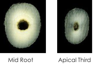 <p>What is the canal shape of a maxillary <strong>lateral</strong> incisor?</p>