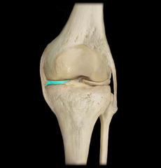 <p>C-shaped piece of fibrocartilage on the inner (medial) side of the knee that sits between the femur and tibia and helps absorb shock and stabilize the knee.</p>