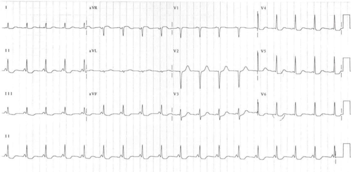 <ul><li><p><span style="background-color: transparent;"><u>Narrow PR interval</u> < 3 small boxes</span></p></li><li><p><span style="background-color: transparent;"><u>Narrow QRS</u> < 1.5 small boxes</span></p></li><li><p><span style="background-color: transparent;">tachycardia</span></p></li></ul><p></p>