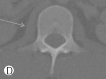 <ol><li><p>large bodies</p></li><li><p>large vertebral foramen</p></li><li><p>no costal facets</p></li></ol><p></p>