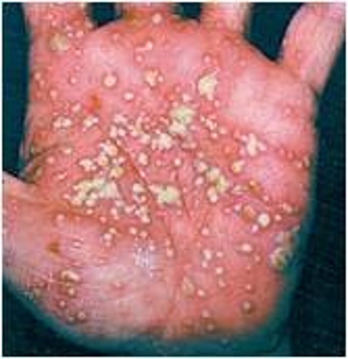 <p>life threatening</p><p>febrile, leukocytes</p><p>side effect of TNF-alpha medication or oral steroid</p><p>usually seen on palms and feet in clinic</p>