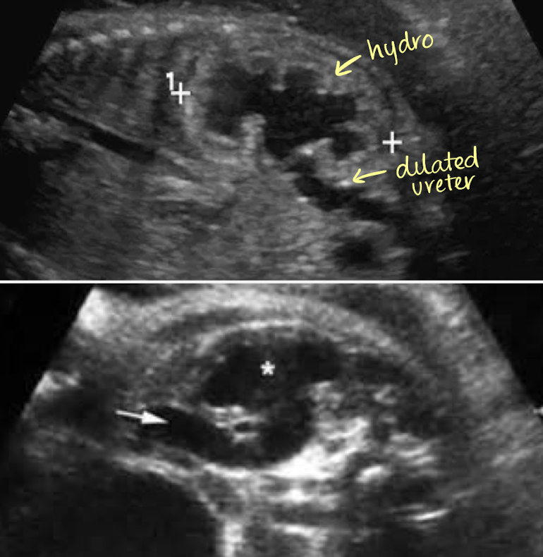 <ul><li><p>affected kidney will have dilation of renal pelvis and ureter</p></li><li><p>ureter will appear tortuous</p></li><li><p>if unilateral, bladder and AFI are normal</p></li><li><p>if bilateral, bladder will be empty and may have oligohydramnios </p></li></ul><p></p>