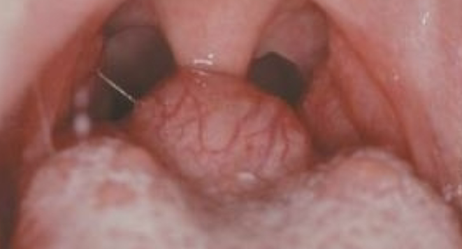 <p>__ % of ectopic thyroids are in this position </p>