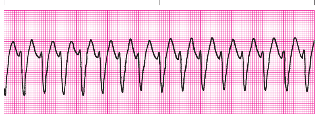 <ol><li><p>Regularity?</p></li><li><p>Rate</p></li><li><p>P Waves</p></li><li><p>PRI</p></li><li><p>QRS</p></li><li><p>Interpretation</p></li></ol><p></p>