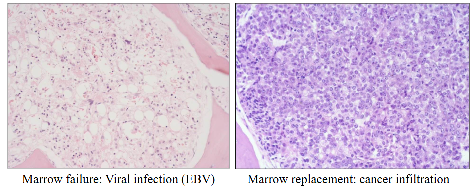 <p>- Inability of BM to produce sufficient blood cells</p><p>- Leads to "pancytopenia"</p><p>.</p><p>Clinical features:</p><p>- Symptoms and signs of anaemia, bleeding, infections</p>