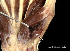 <p>In this anterior view of the right hand, identify the muscle indicated by the arrow.</p>
