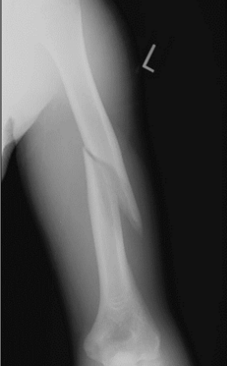 <p>Humeral Shaft Fractures</p>