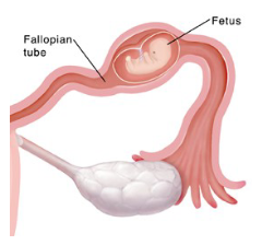 <p>Ectopic pregnancy</p><ul><li><p>DX</p></li><li><p>care management</p></li><li><p>medication</p></li><li><p>surgery </p></li></ul><p></p>
