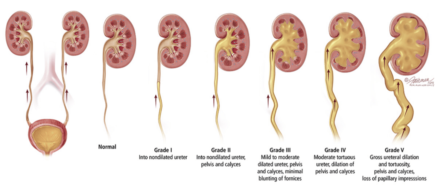 <p>Retrograde regurgitation of urine from the bladder into the ureters/kidneys</p>