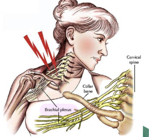 <ul><li><p>stretching/compression of brachial plexus</p></li><li><p>disrupts peripheral nerve function</p></li><li><p>common in contact sports</p></li></ul><p></p>