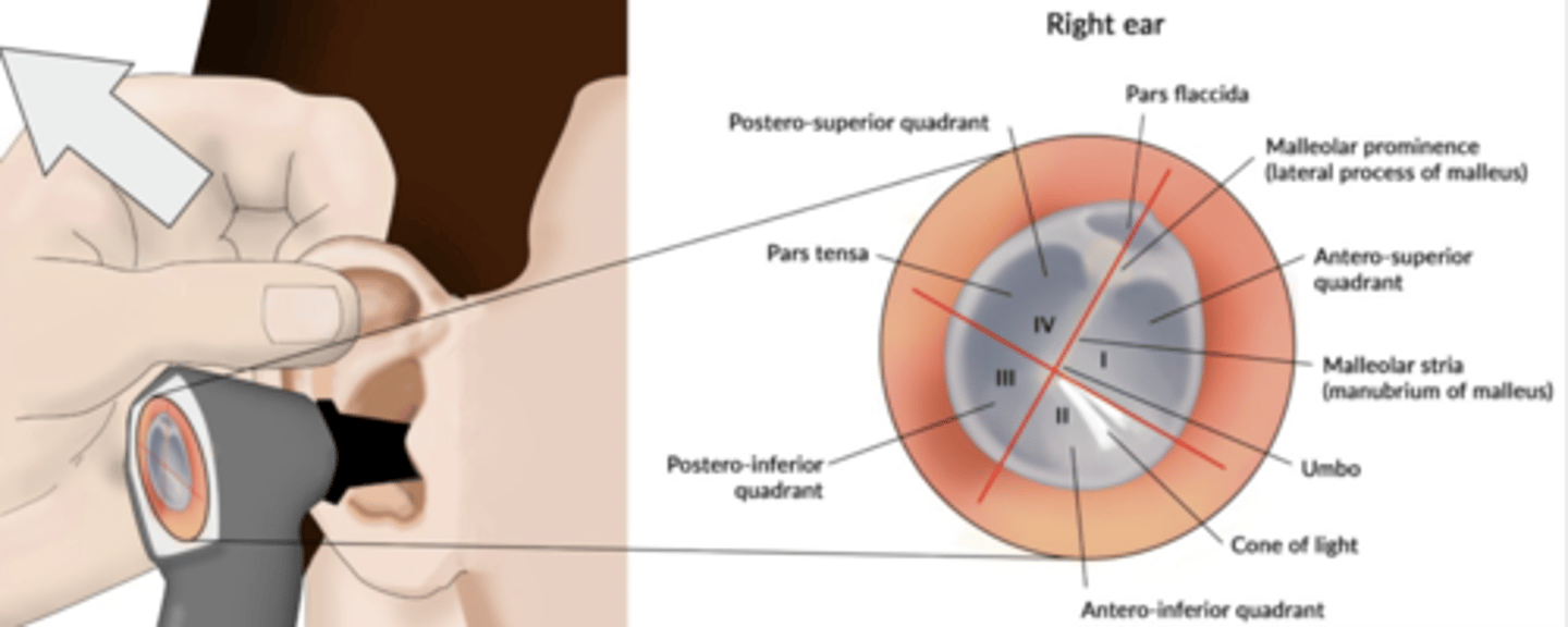 <p>A) antero-inferior quadrant</p><p>EXPLANATION</p><p>In paracentesis the preferred quadrant is the anterior inferior since there is no structure behind it that we can damage, and the fluid easily flows out from there.</p>
