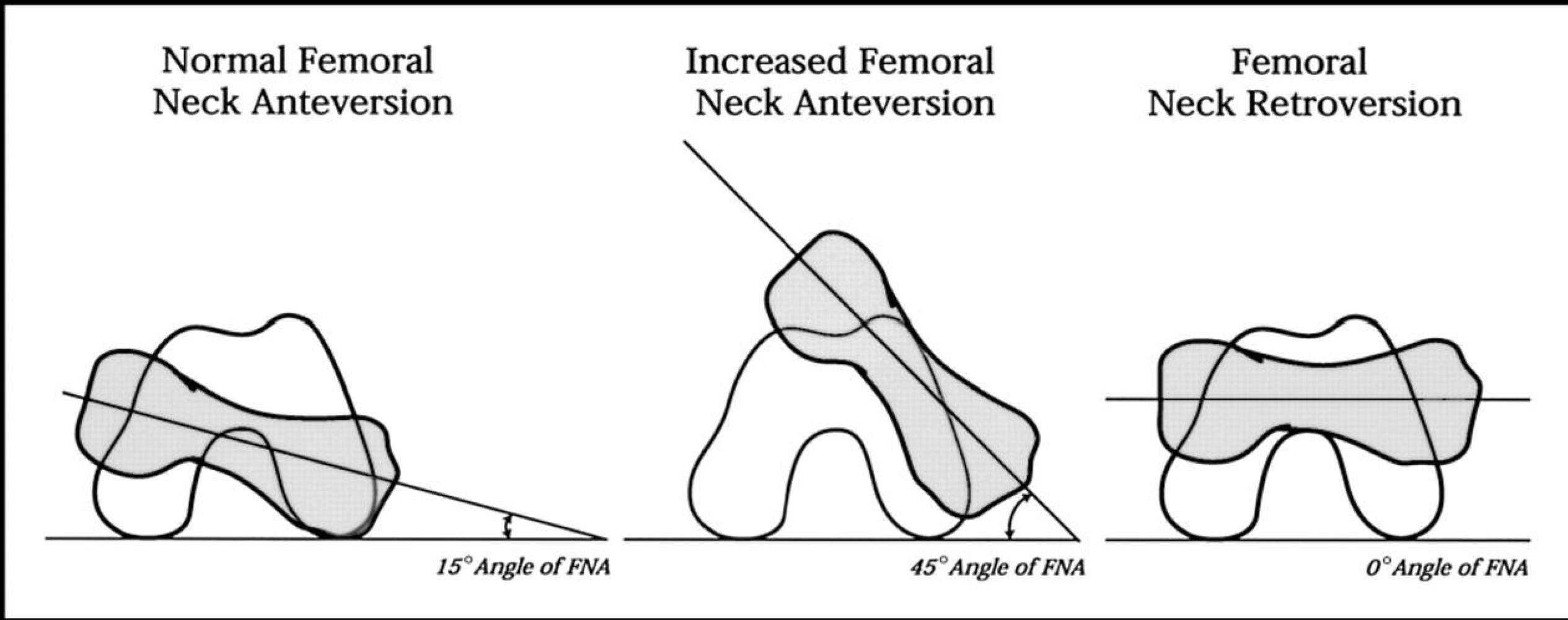 <ul><li><p>internal rotation of the hip with the femur in torsion</p></li><li><p>the femoral head and neck are rotated anteriorly</p></li><li><p>during development as we begin to weight bear, femoral anterversion will start externally rotating to set the hips. so if we are super late walking, we can get stuck in this femoral anteversion position (IR)</p></li></ul><p></p>
