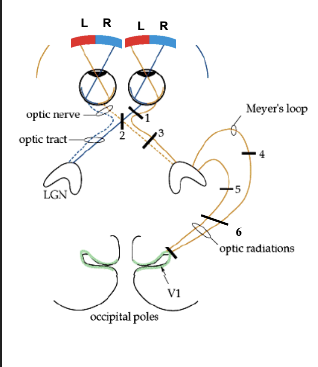 <p>can see out of left eye </p>