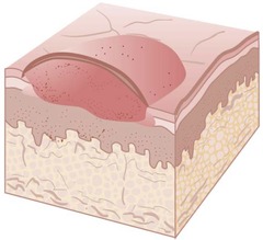 <p>Primary lesion; a solid, elevated, flat-top lesion with indistinct borders.</p><p>It is found on the skin or mucous membrane.</p><p>Psoriasis is an example of a plaque.</p>