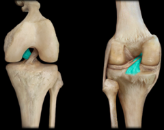 <p>Definition: An intracapsular ligament inside the knee that connects the femur to the tibia and helps stabilize the knee by preventing the tibia from sliding too far backward</p><p>(1) Ligament Type?</p><p> - Intracapsular </p><p>(2) Movement it Prevents?</p><p> - Prevents posterior translation of the tibia in relation to the femur</p><p>(3) How does it Rupture?</p><p> - ruptures from landing on tibial tuberosity with flexed knee</p>