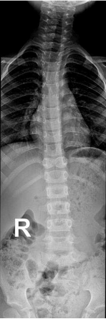 <p>Failure of the center of the vertebral body to ossify properly</p>