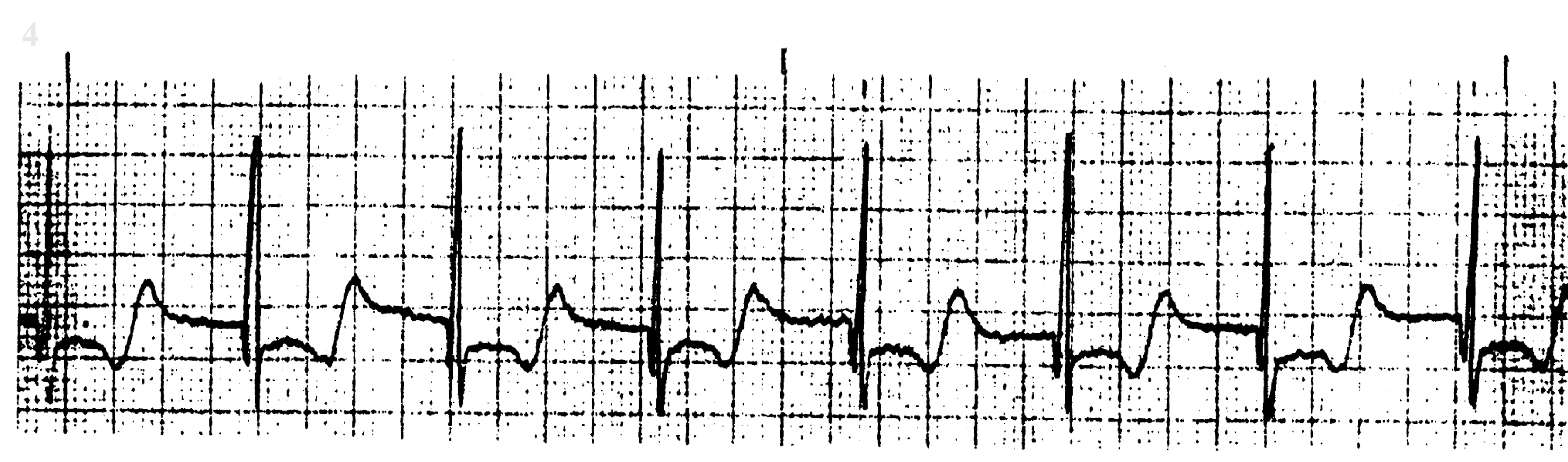 <p>What ECG</p>