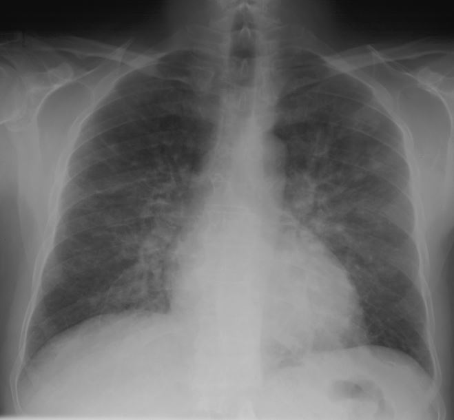<p>poslabšanje respiratorne insuficience ob AMI</p>