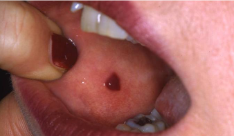 <p>slightly larger than 1-2 mm (max 1cm); single or multiple red or purple spots; do not blanch with pressure; due to vascular problems, platelet disorders, vit C deficiency </p>