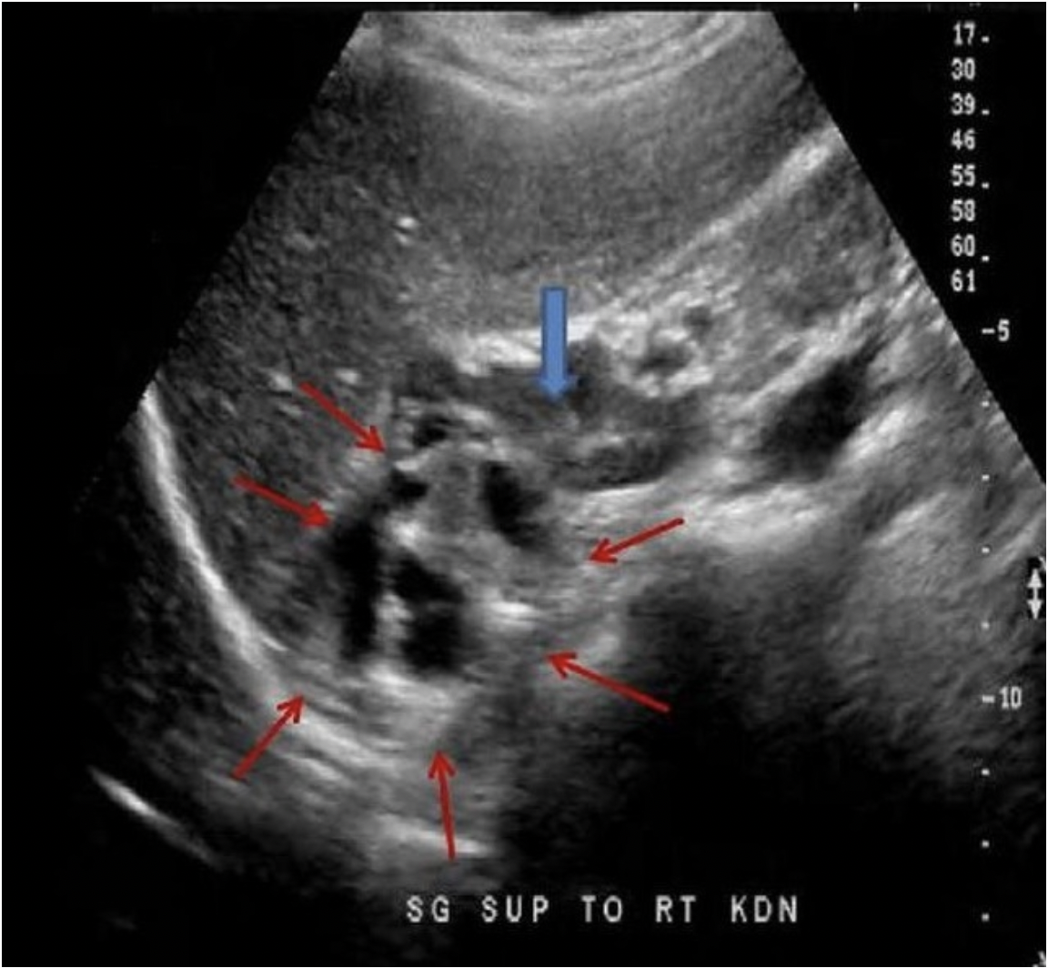 <p>The blue arrow indicates the adrenal gland in a 30 yr old male with a palpable flank mass and no other related history. Which of the following best describes the findings on the image demonstrated by the red arrows?</p><p class="p1">A. complex adrenal mass located superior to the gland, most likely cortical carcinoma</p><p class="p1">B. complex renal mass extending superior to the adrenal gland, most likely medullary sponge kidney</p><p class="p1">C. dilated bowel loops posterior to the adrenal gland, most likely an intestinal hernia</p><p class="p1">D. complex adrenal mass, most likely a lipoma</p>