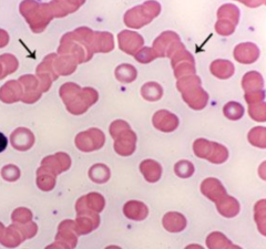 <p>Serum protein abnormality; e.g., ↑globulins or fibrinogen. Seen in multiple myeloma & macroglobulinemia. May be artifact due to delay in spreading drop of blood or smear that's too thick.</p>
