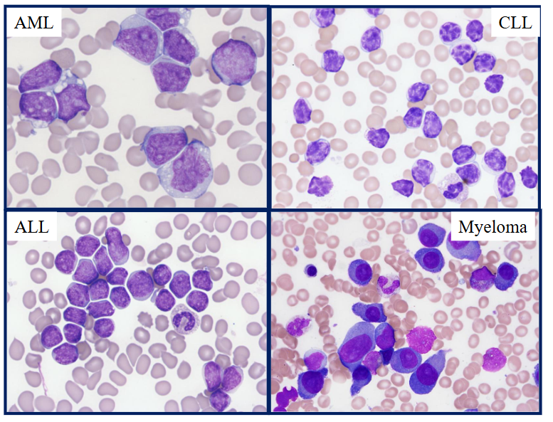 <p>Blood Cancers</p>