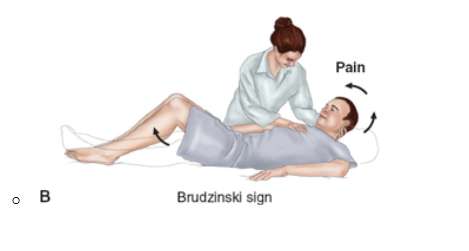 <p>Brudzinski Sign </p><p></p>